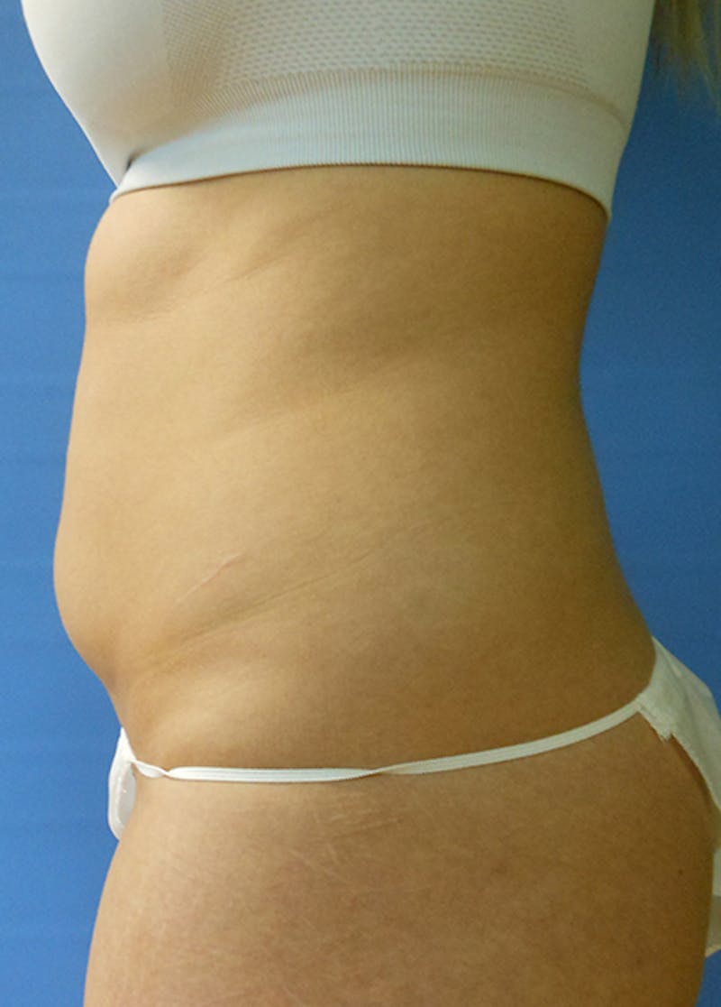 Abdomen Before & After Gallery - Patient 51821683 - Image 3