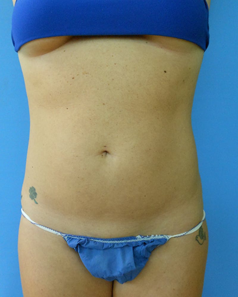 Abdomen Before & After Gallery - Patient 51821684 - Image 1