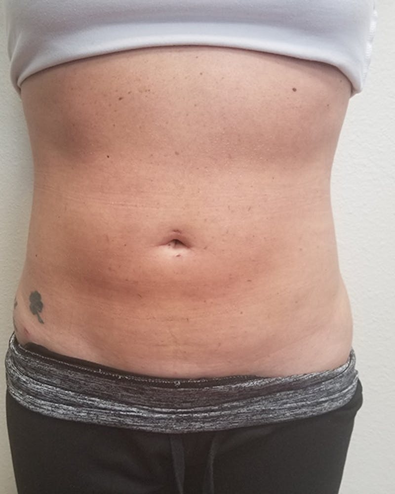 Abdomen Before & After Gallery - Patient 51821684 - Image 2
