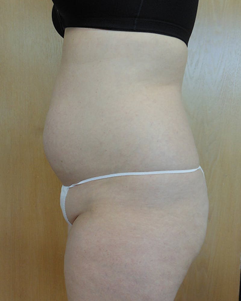 Abdomen Before & After Gallery - Patient 51821685 - Image 1