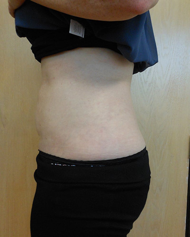 Abdomen Before & After Gallery - Patient 51821685 - Image 2