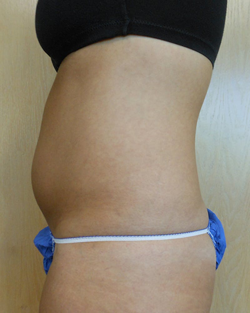 Abdomen Before & After Gallery - Patient 51821749 - Image 3