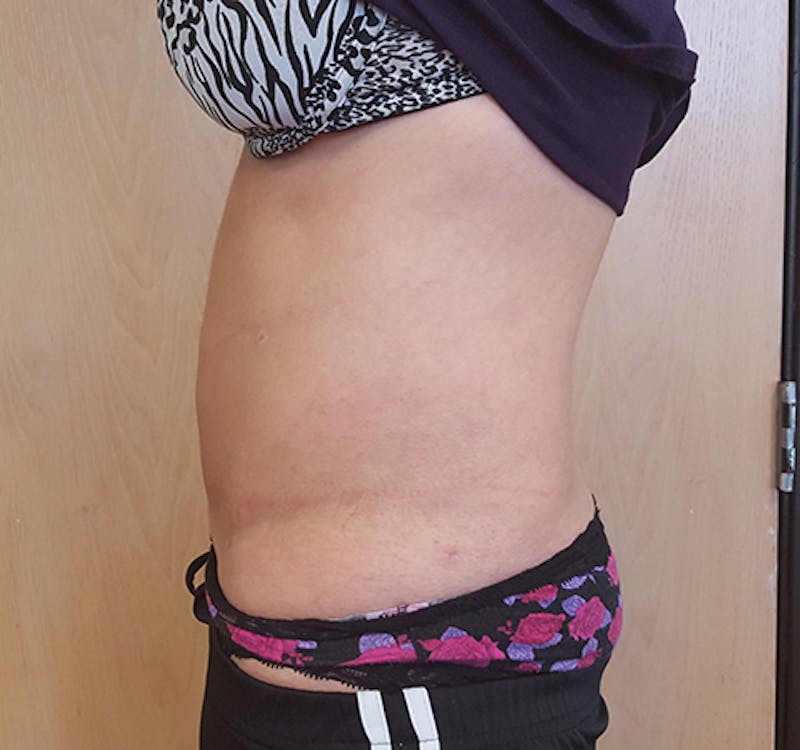 Abdomen Before & After Gallery - Patient 51821749 - Image 4