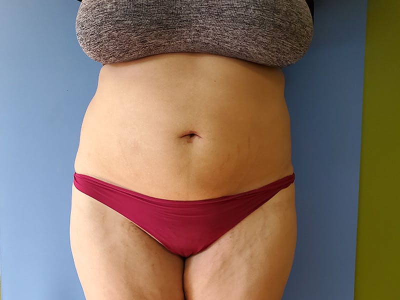 Abdomen Before & After Gallery - Patient 51821750 - Image 2