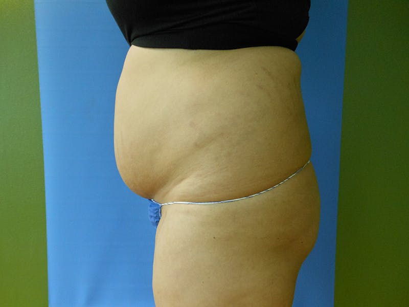 Abdomen Before & After Gallery - Patient 51821750 - Image 3