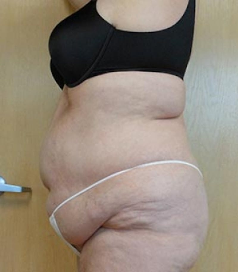 Abdomen Before & After Gallery - Patient 51821751 - Image 1