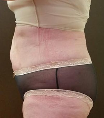 Abdomen Before & After Gallery - Patient 51821751 - Image 2