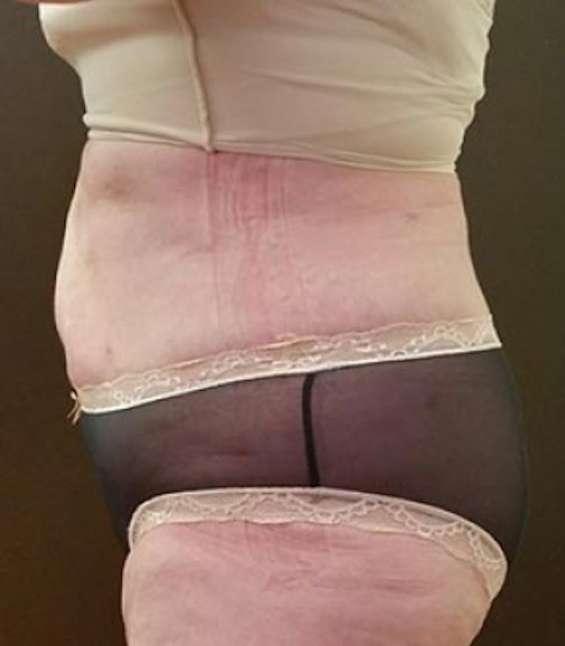 Abdomen Before & After Gallery - Patient 51821751 - Image 2