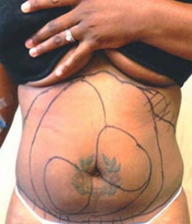 Abdomen Before & After Gallery - Patient 51821753 - Image 1