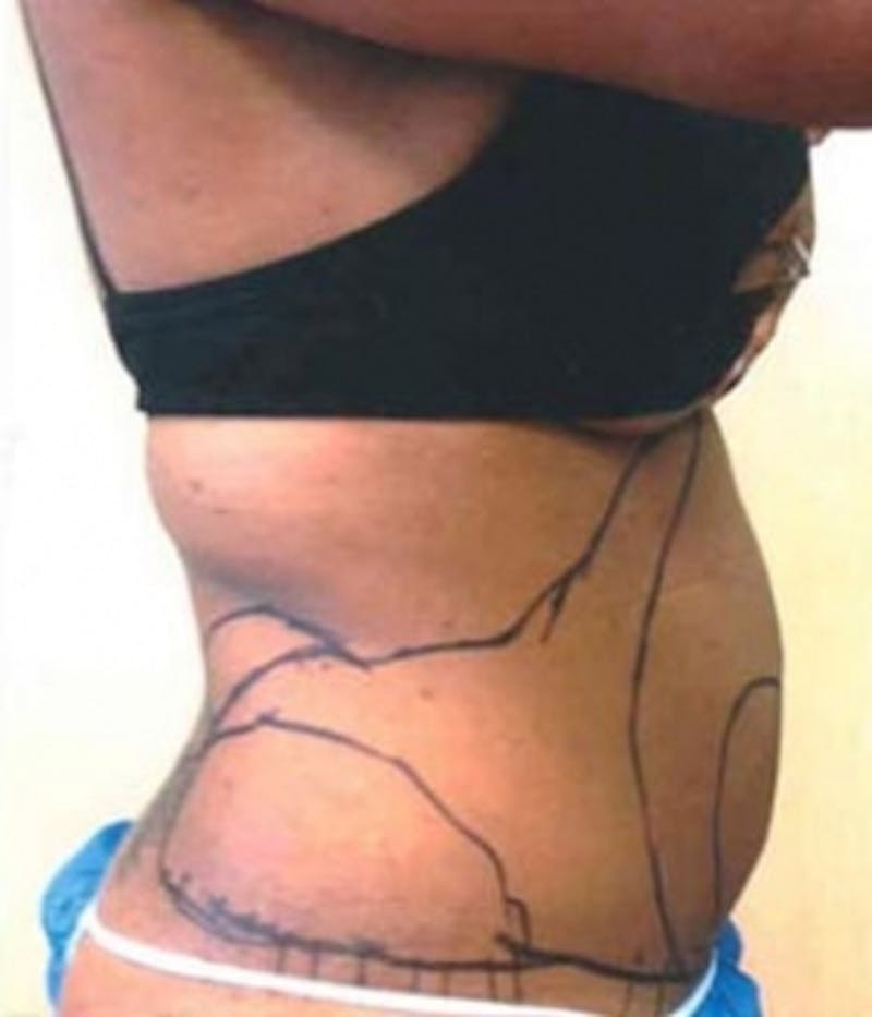 Abdomen Before & After Gallery - Patient 51821753 - Image 3
