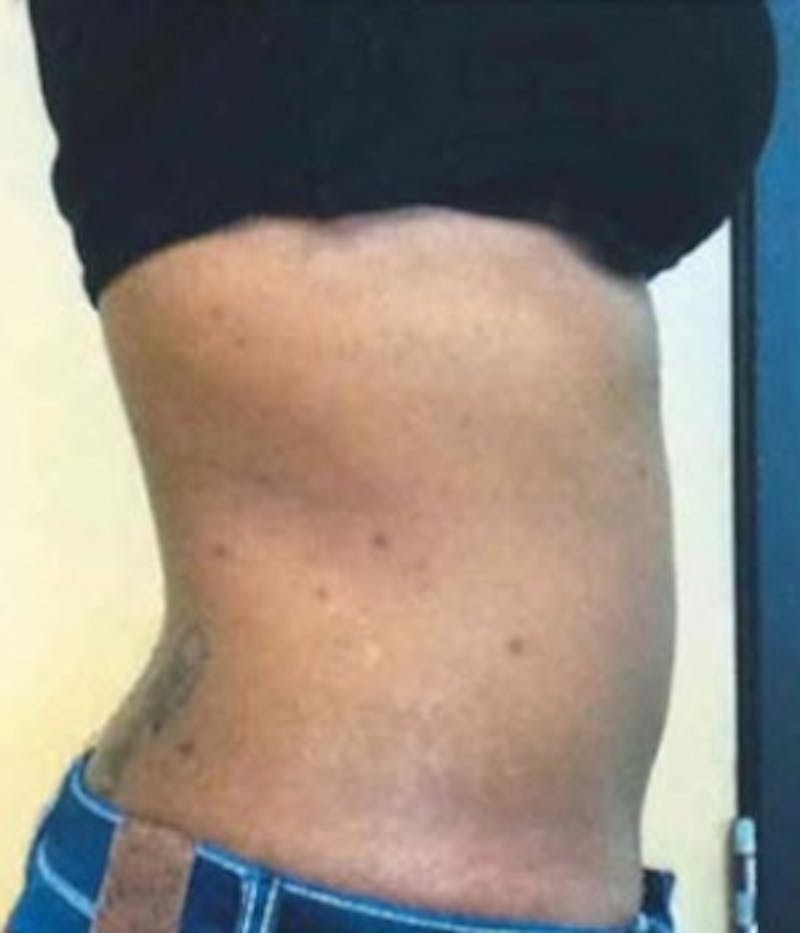 Abdomen Before & After Gallery - Patient 51821753 - Image 4