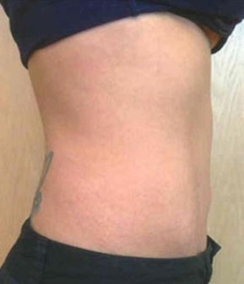 Abdomen Before & After Gallery - Patient 51821754 - Image 4