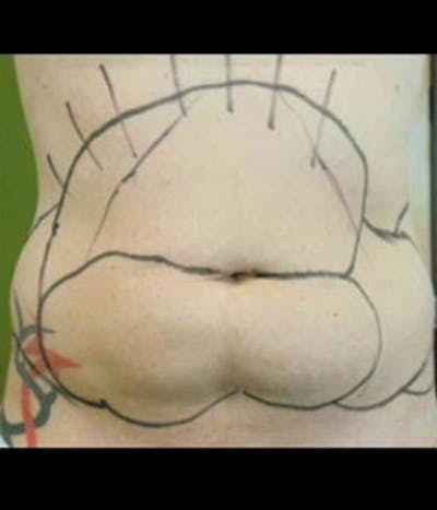 Abdomen Before & After Gallery - Patient 51821755 - Image 1