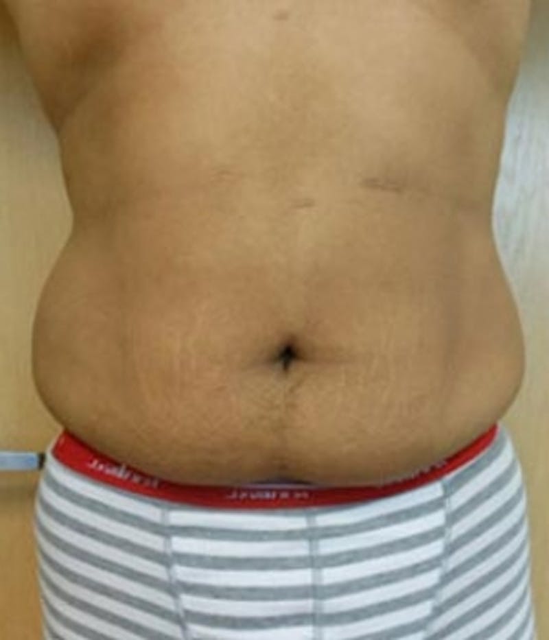 Abdomen Before & After Gallery - Patient 51821756 - Image 1