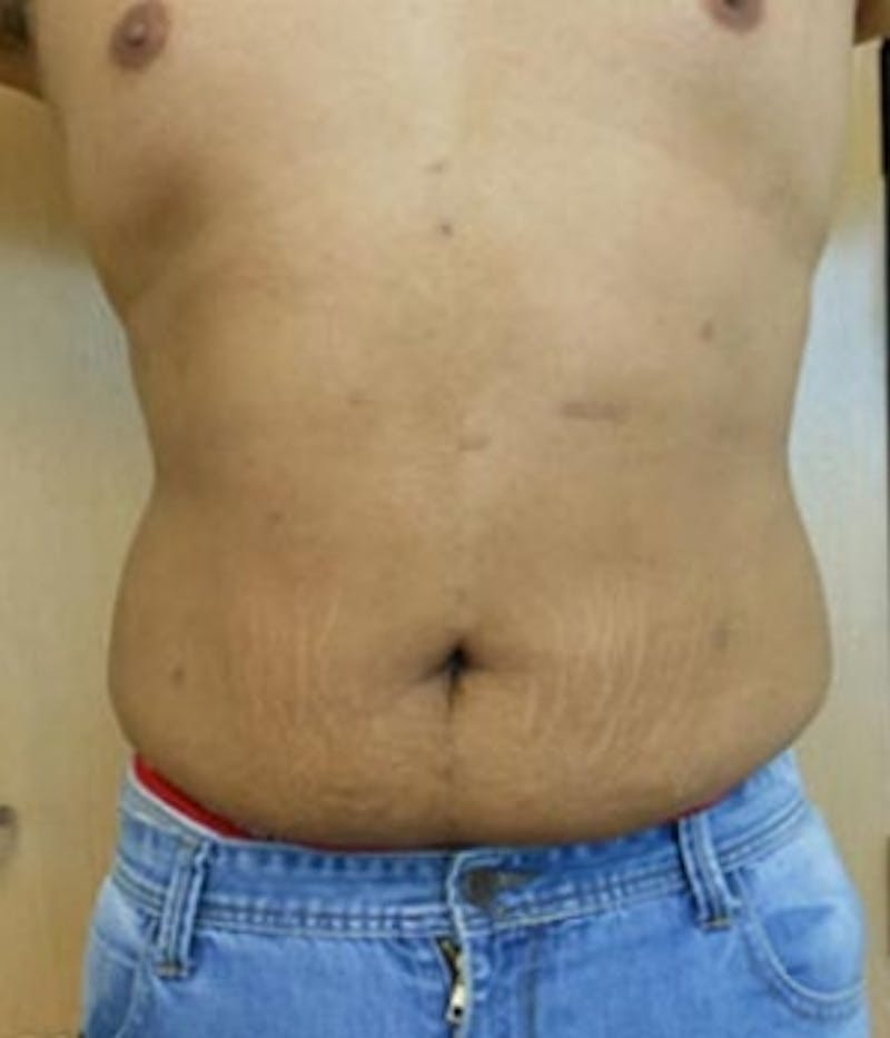 Abdomen Before & After Gallery - Patient 51821756 - Image 2