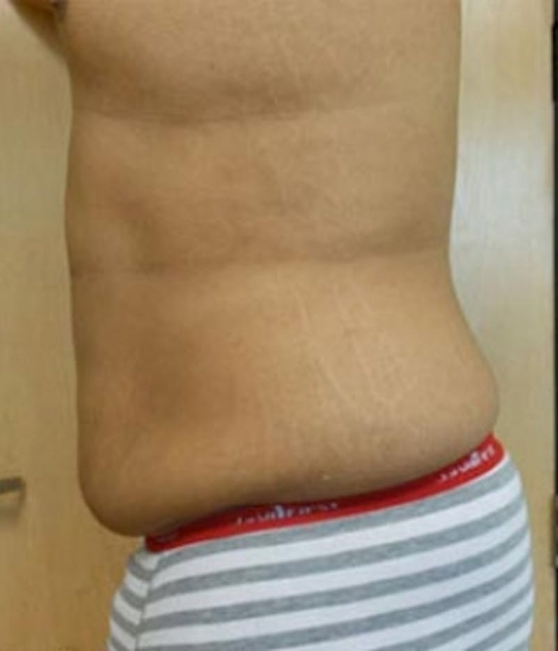 Abdomen Before & After Gallery - Patient 51821756 - Image 3