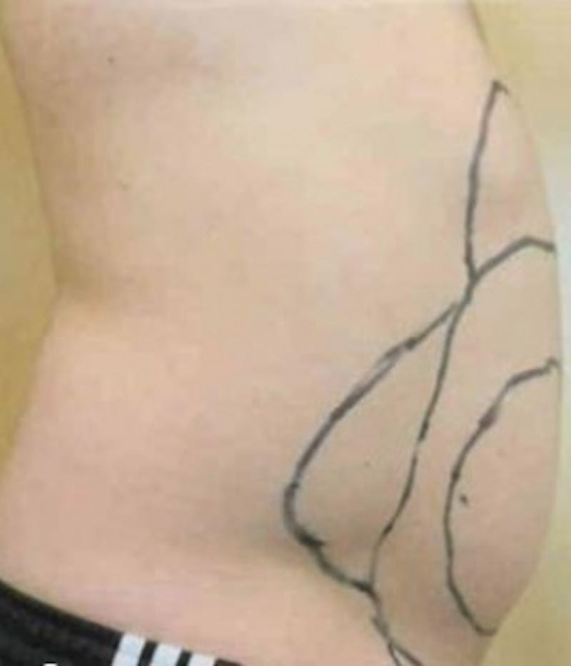 Abdomen Before & After Gallery - Patient 51821757 - Image 3