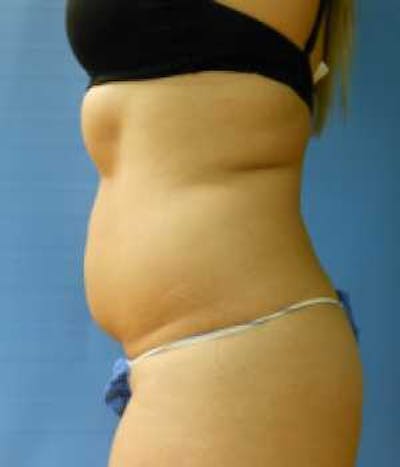 Abdomen Before & After Gallery - Patient 51821759 - Image 1