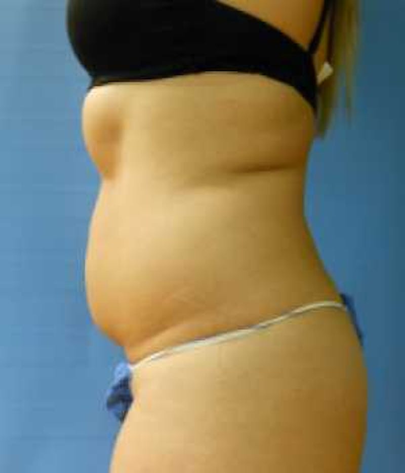 Abdomen Before & After Gallery - Patient 51821759 - Image 1
