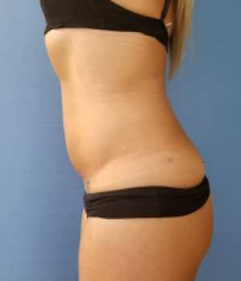 Abdomen Before & After Gallery - Patient 51821759 - Image 2
