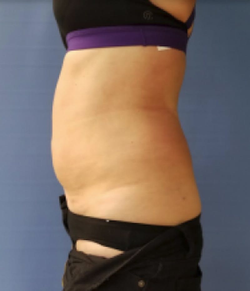 Abdomen Before & After Gallery - Patient 51821760 - Image 2