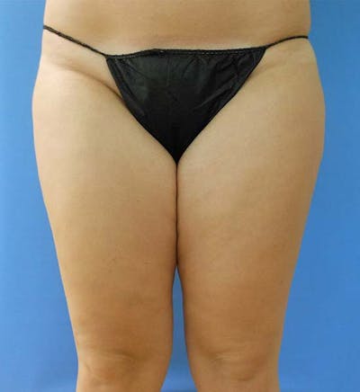 Inner Thigh Before & After Gallery - Patient 57609316 - Image 1