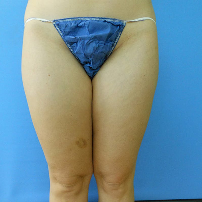 Inner Thigh Before & After Gallery - Patient 57609317 - Image 1