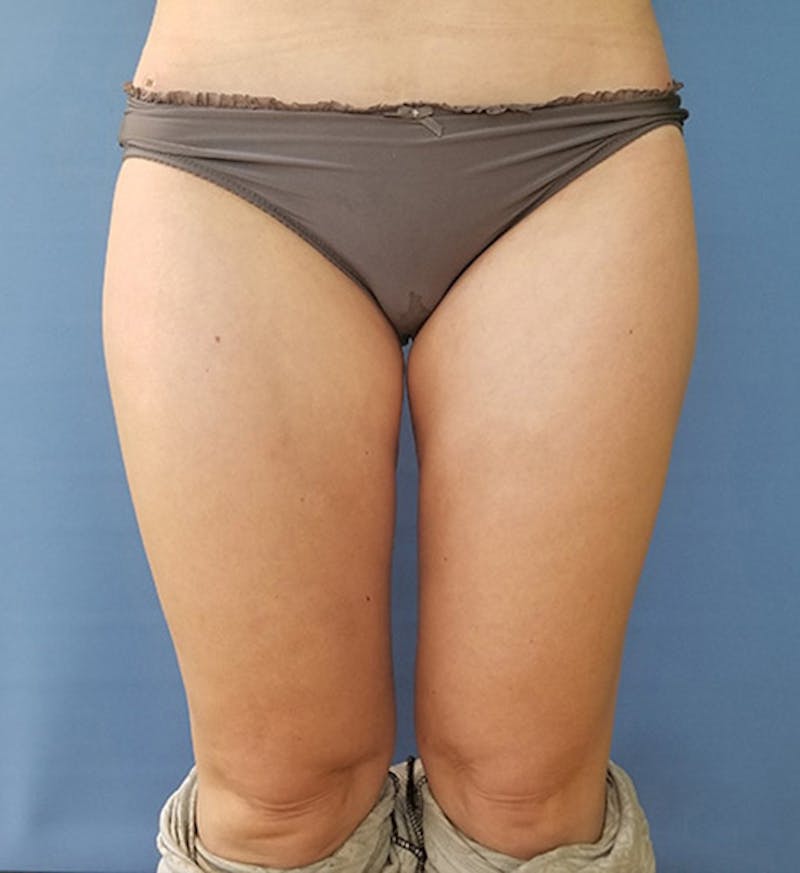 Inner Thigh Before & After Gallery - Patient 57609317 - Image 2