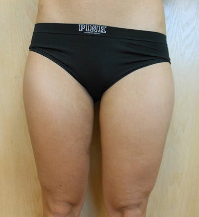 Inner Thigh Before & After Gallery - Patient 57609319 - Image 2