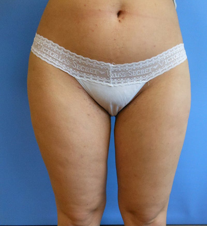 Inner Thigh Before & After Gallery - Patient 57609322 - Image 2