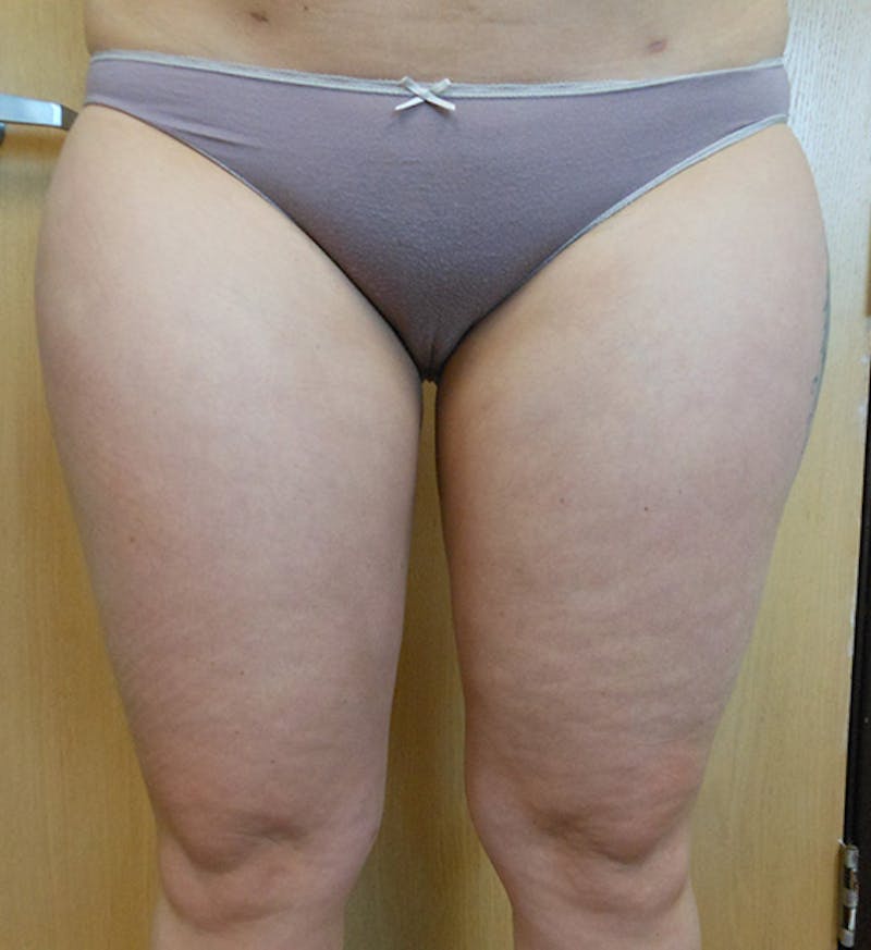 Inner Thigh Before & After Gallery - Patient 57609323 - Image 2