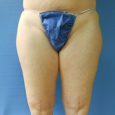 Inner Thigh Before & After Gallery - Patient 57609324 - Image 1