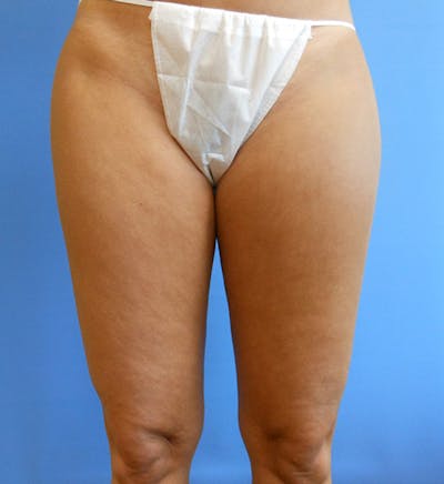 Inner Thigh Before & After Gallery - Patient 57609325 - Image 1