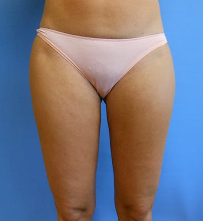 Inner Thigh Before & After Gallery - Patient 57609325 - Image 2