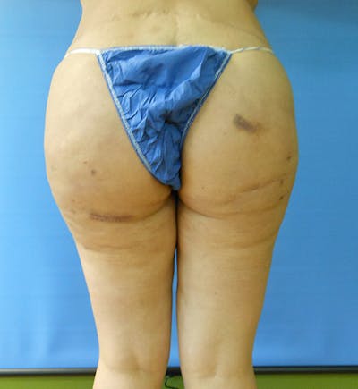 Inner Thigh Before & After Gallery - Patient 57609327 - Image 1
