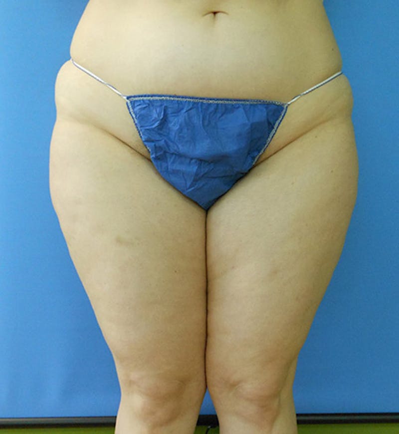 Inner Thigh Before & After Gallery - Patient 57609328 - Image 1