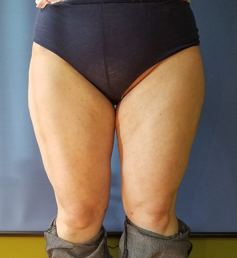 Inner Thigh Before & After Gallery - Patient 57609328 - Image 2