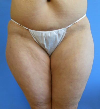 Inner Thigh Before & After Gallery - Patient 57609333 - Image 1