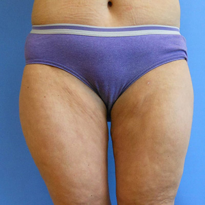 Inner Thigh Before & After Gallery - Patient 57609333 - Image 2