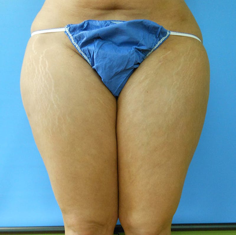 Inner Thigh Before & After Gallery - Patient 57609335 - Image 1