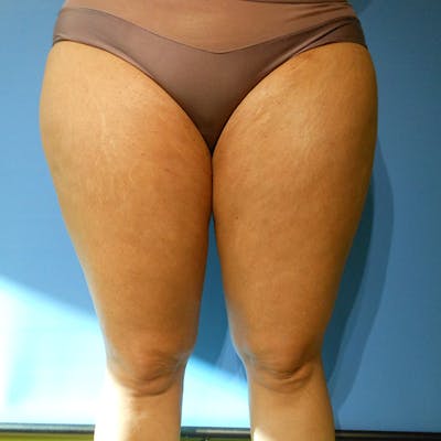 Inner Thigh Before & After Gallery - Patient 57609335 - Image 2