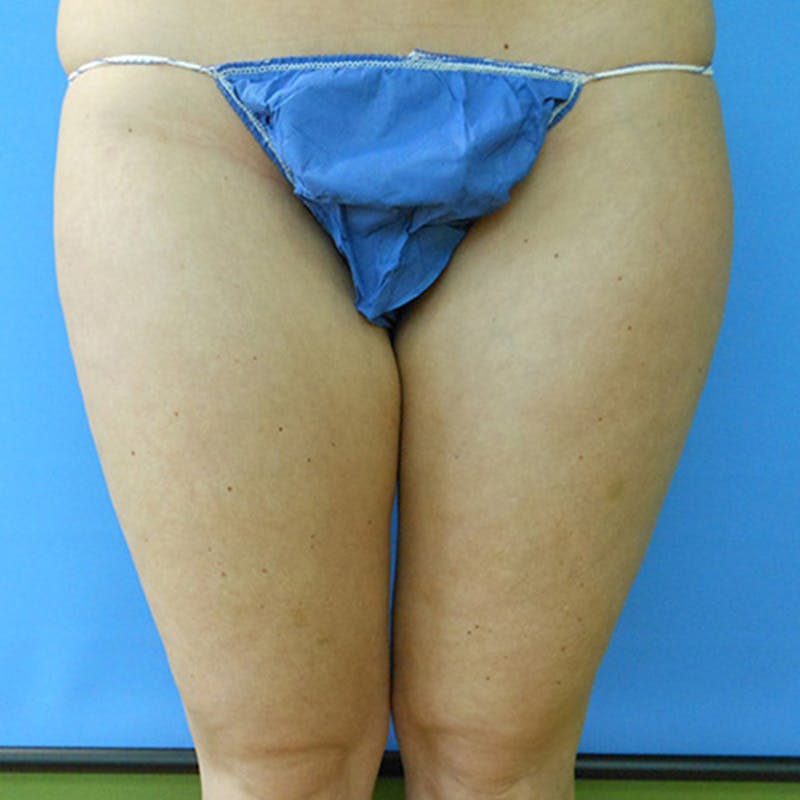 Inner Thigh Before & After Gallery - Patient 57609341 - Image 1