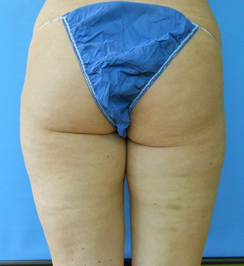 Inner Thigh Before & After Gallery - Patient 57609341 - Image 3