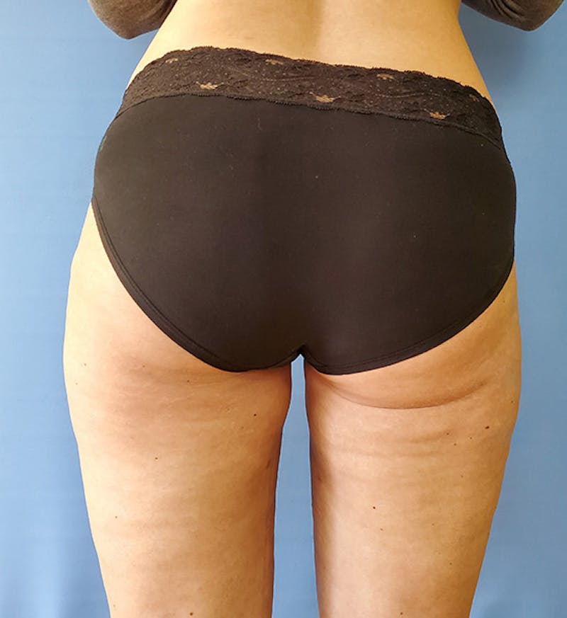 Inner Thigh Before & After Gallery - Patient 57609341 - Image 4