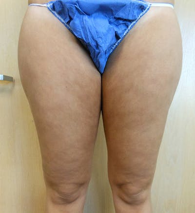 Inner Thigh Before & After Gallery - Patient 57609346 - Image 1