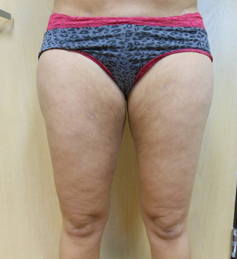 Inner Thigh Before & After Gallery - Patient 57609346 - Image 2