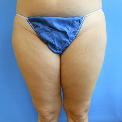 Inner Thigh Before & After Gallery - Patient 57609349 - Image 1