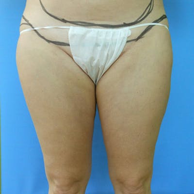Inner Thigh Before & After Gallery - Patient 57609349 - Image 2