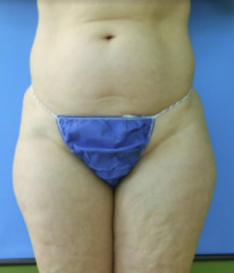 Inner Thigh Before & After Gallery - Patient 57609351 - Image 1