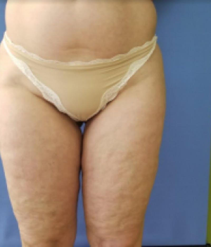 Inner Thigh Before & After Gallery - Patient 57609351 - Image 2